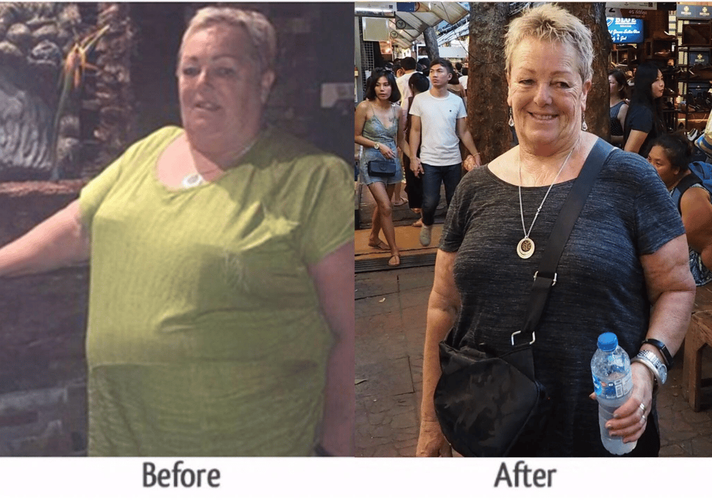 Gastric Sleeve Thailand Sharlene lost 45 kgs 1 year after gastric